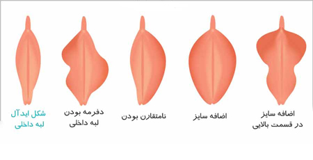تفاوت های ظاهری واژن