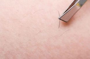 مو زیرپوستی چیست و چطور درمان می شود؟