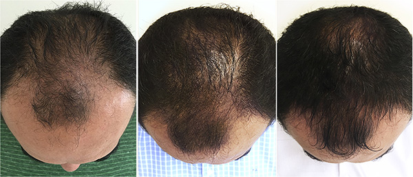 مزوتراپی مو چیست